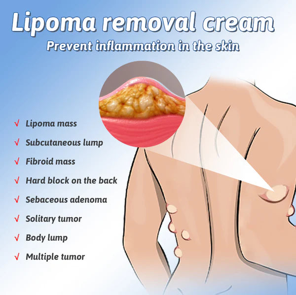 LipoCare™ Lipoma Removal Cream 🩺